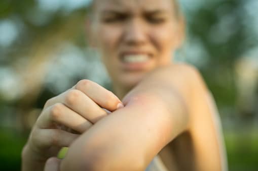 A woman scratching her itchy mosquito bite. Tropical climate danger.